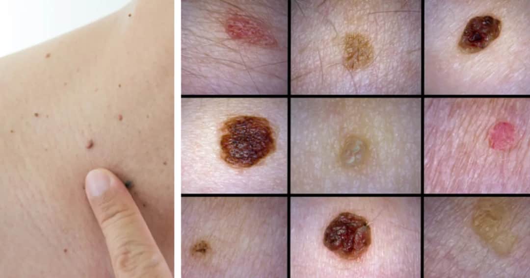 Mały czarny pieprzyk: kiedy powinieneś zgłosić się do lekarza?